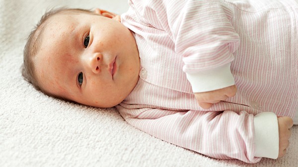 新生儿胸部的黄疸是最严重的吗？